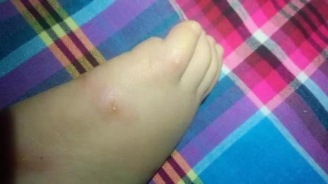 夏季蟲咬急救攻略，家有孩子的更要看看