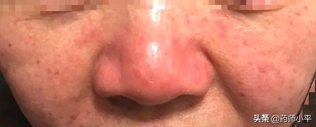 面部發(fā)紅癢癢、反復(fù)過敏，可能是在提醒做這一件事情，該清除螨了