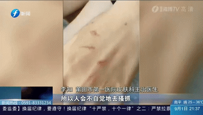 別再關燈玩手機了！這種蟲會毀容！切記不要拍......